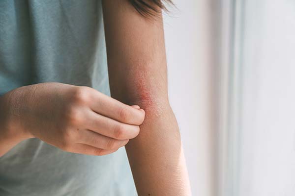 Eczema