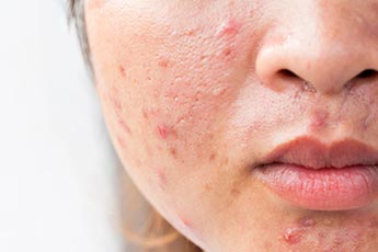 m_acne
