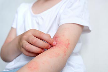 m_eczema