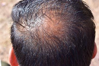 m_hair_loss