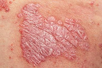 m_psoriasis