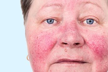 m_rosacea