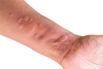 m_urticaria2