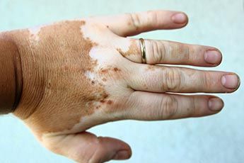 m_vitiligo